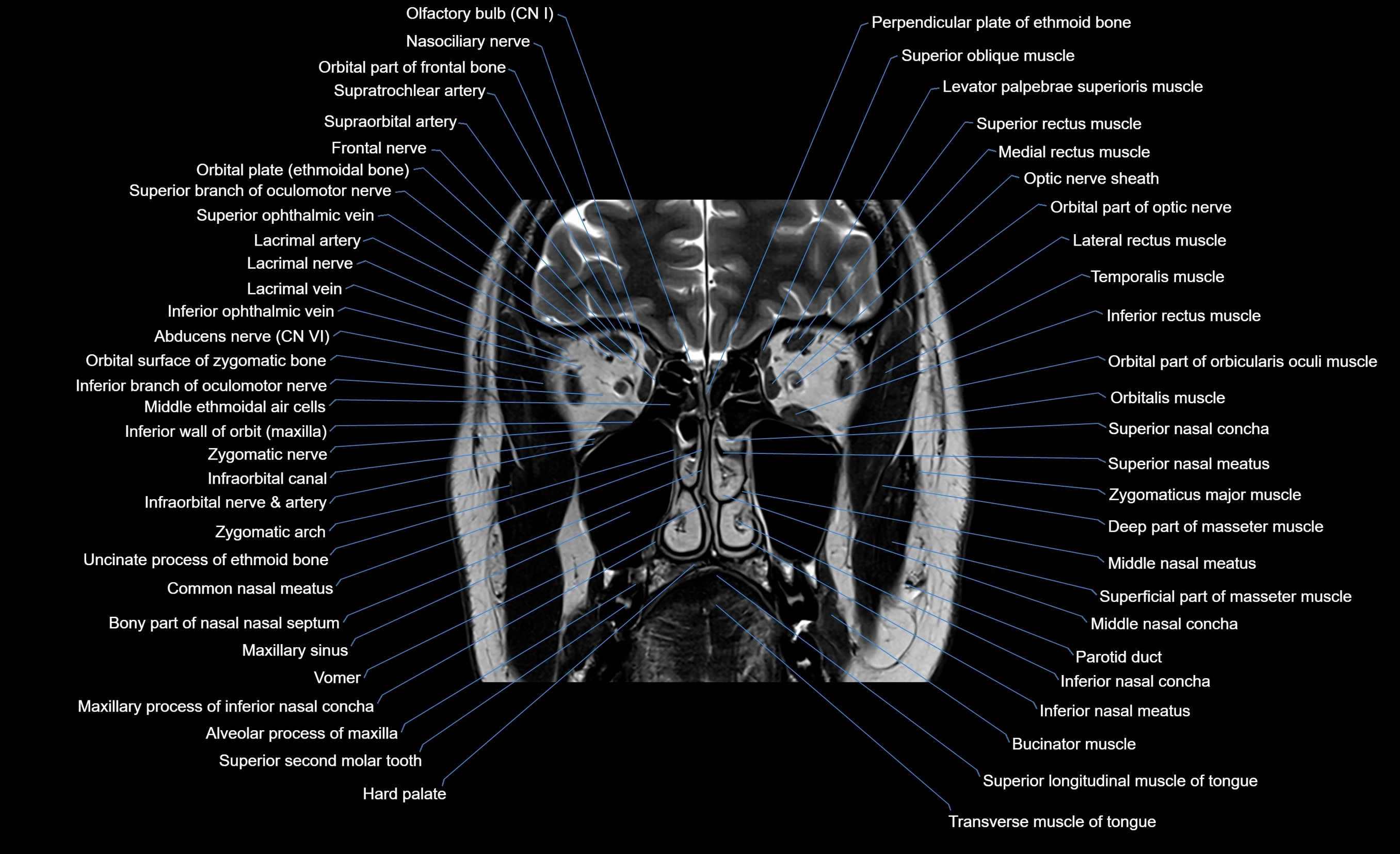 MRI face & paranasal sinuses(PNS) labelled  coronal  cross sectional anatomy 3T radiology  image-img-00001-00023.webp